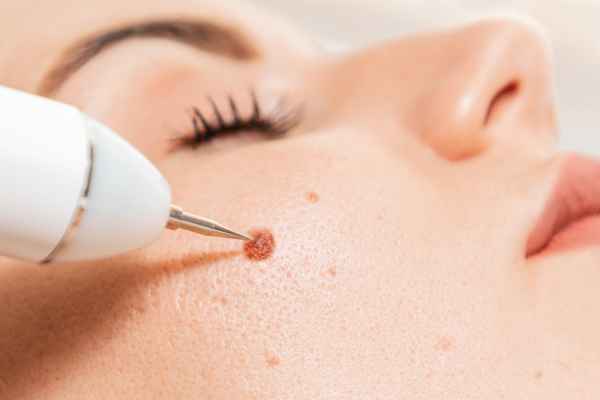 CryoPen: 5 Skin Concerns It May Be Used to Treat 3 What actually happens during a CryoPen treatment Falkirk?